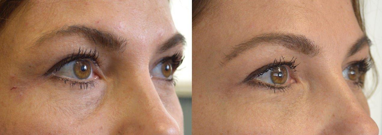 Side-by-side close-up of a woman’s eyes before and after cataract surgery, showing reduced wrinkles and smoother skin around the eyes in the after image.