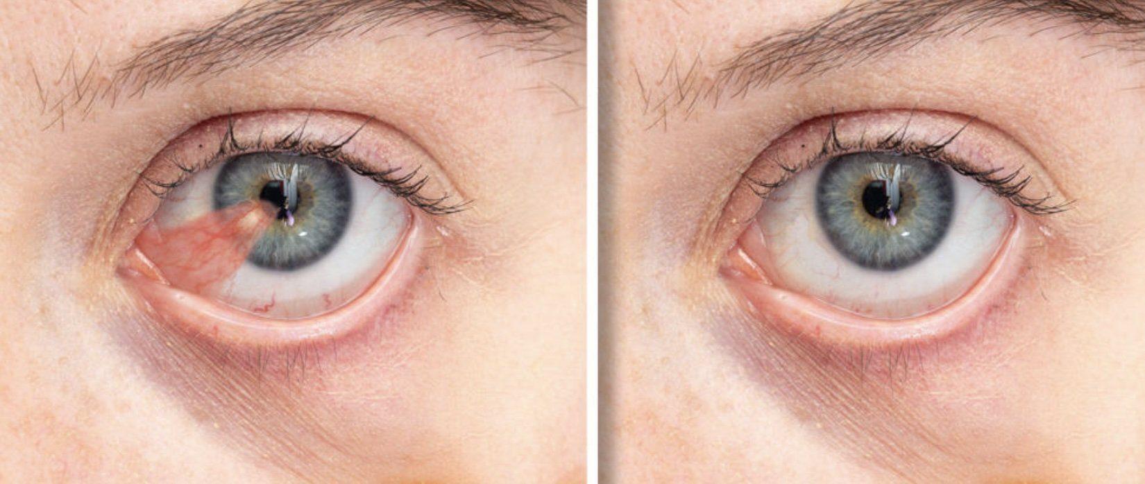 Two close-up images of a blue-gray eye: the left shows a red, fleshy pterygium growth, while the right displays the same eye after pterygium surgery. Recovery time varies; ask your doctor about driving after pterygium surgery.