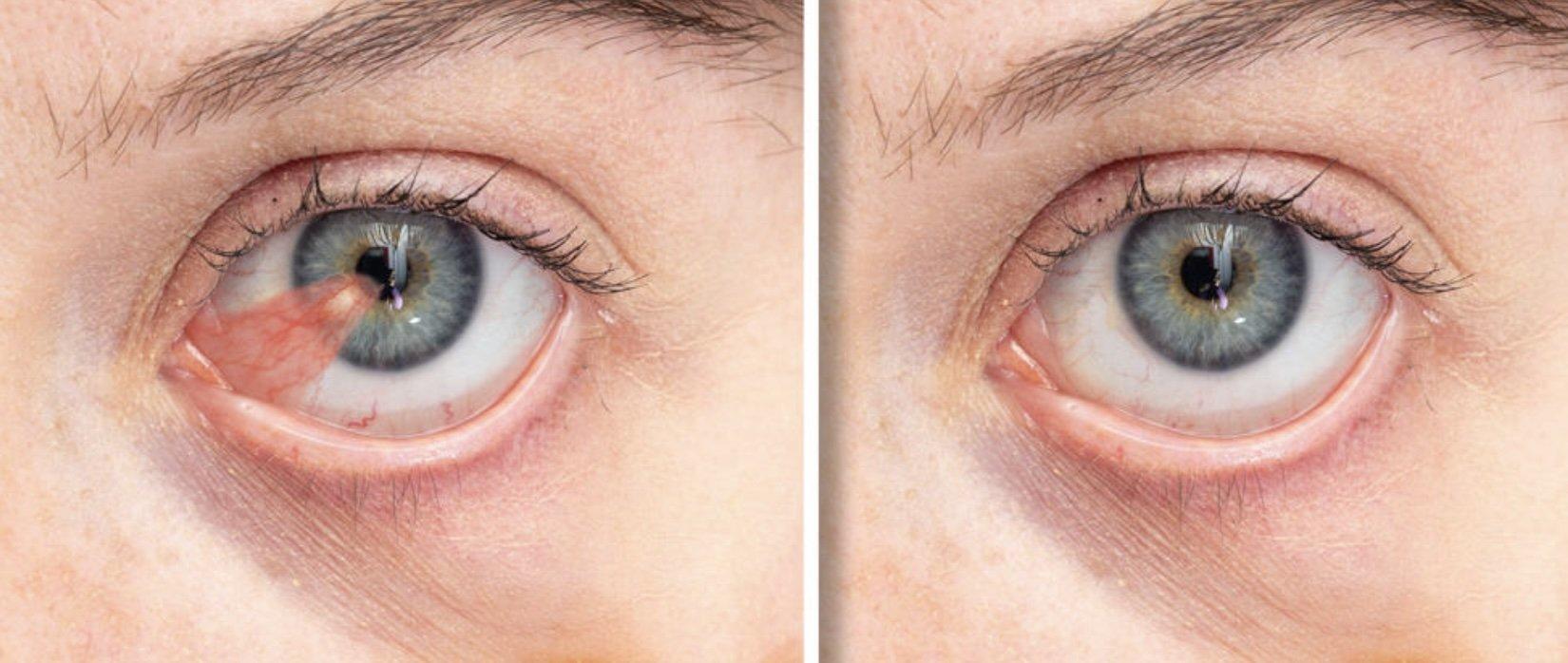 Two close-up images of a blue-gray eye: the left shows a red, fleshy pterygium growth, while the right displays the same eye after pterygium surgery. Recovery time varies; ask your doctor about driving after pterygium surgery.