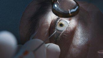 A close-up view of an eye during cataract eye surgery, with a gloved hand holding an instrument near the eye and a magnifying lens focused on the pupil.