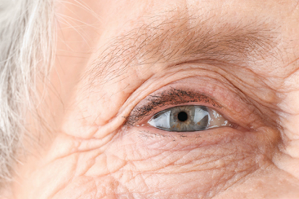 Close-up of an elderly person's face, focusing on a blue eye surrounded by wrinkles and fine lines—perfect for illustrating topics like astigmatism or advanced procedures such as topography-guided laser correction.