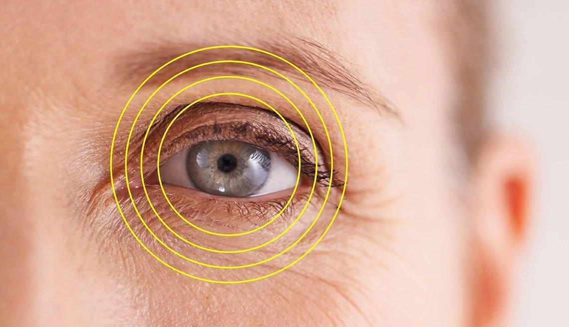 A close-up of a person's blue eye with yellow concentric circles digitally overlaid around the eye, illustrating how topography-guided laser correction highlights and precisely maps the area for correcting astigmatism.