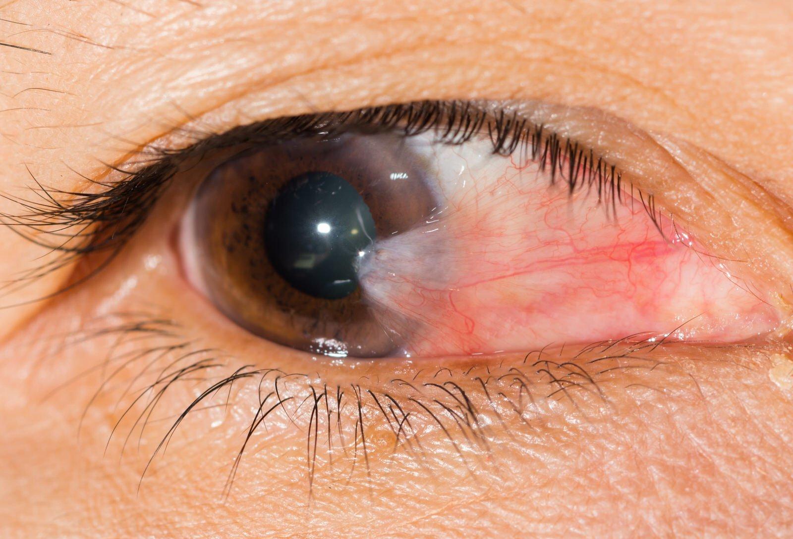 A close-up of a human eye shows a pinkish growth, likely pterygium, extending from the inner corner towards the cornea. The image highlights details of the skin and eyelashes, often referenced when discussing recovery time after pterygium surgery.