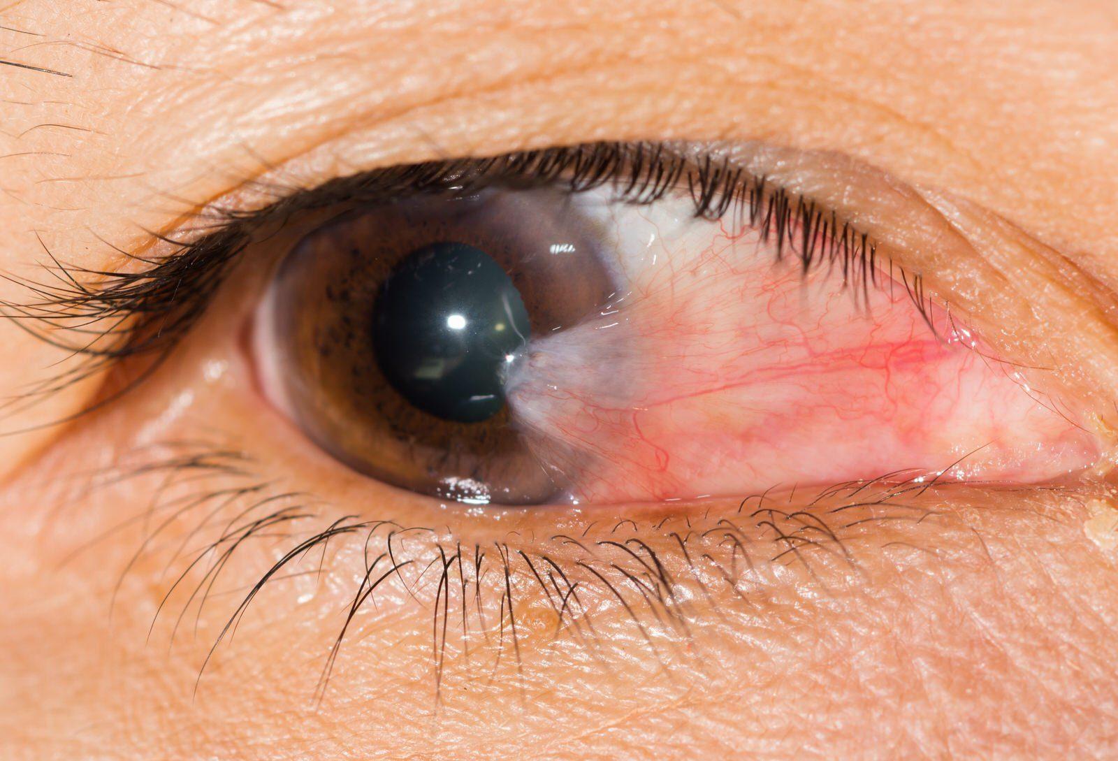 A close-up of a human eye shows a pinkish growth, likely pterygium, extending from the inner corner towards the cornea. The image highlights details of the skin and eyelashes, often referenced when discussing recovery time after pterygium surgery.