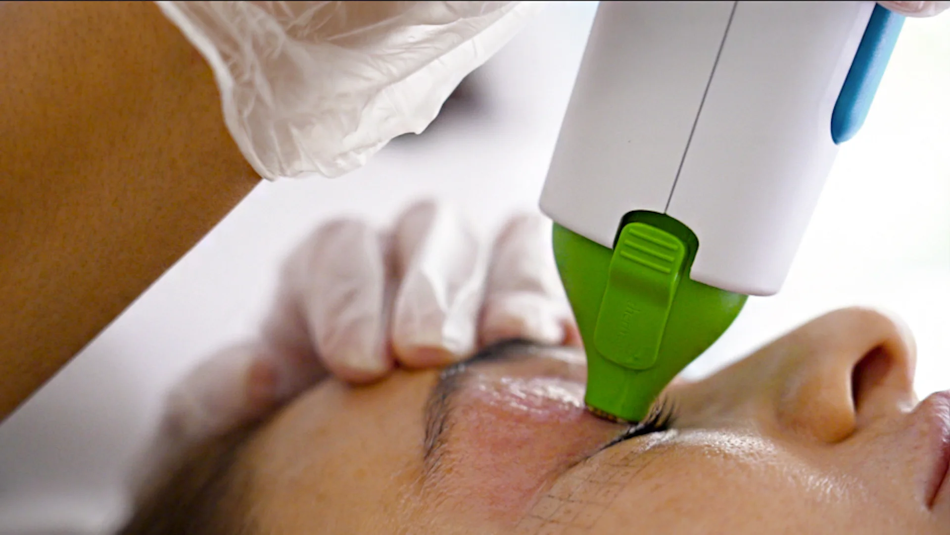 A close-up of a person receiving a cosmetic procedure near the eye area, with a gloved hand holding a device with a green attachment to the skin under the eyebrow—similar to tools used in cataract treatment for blurred vision.