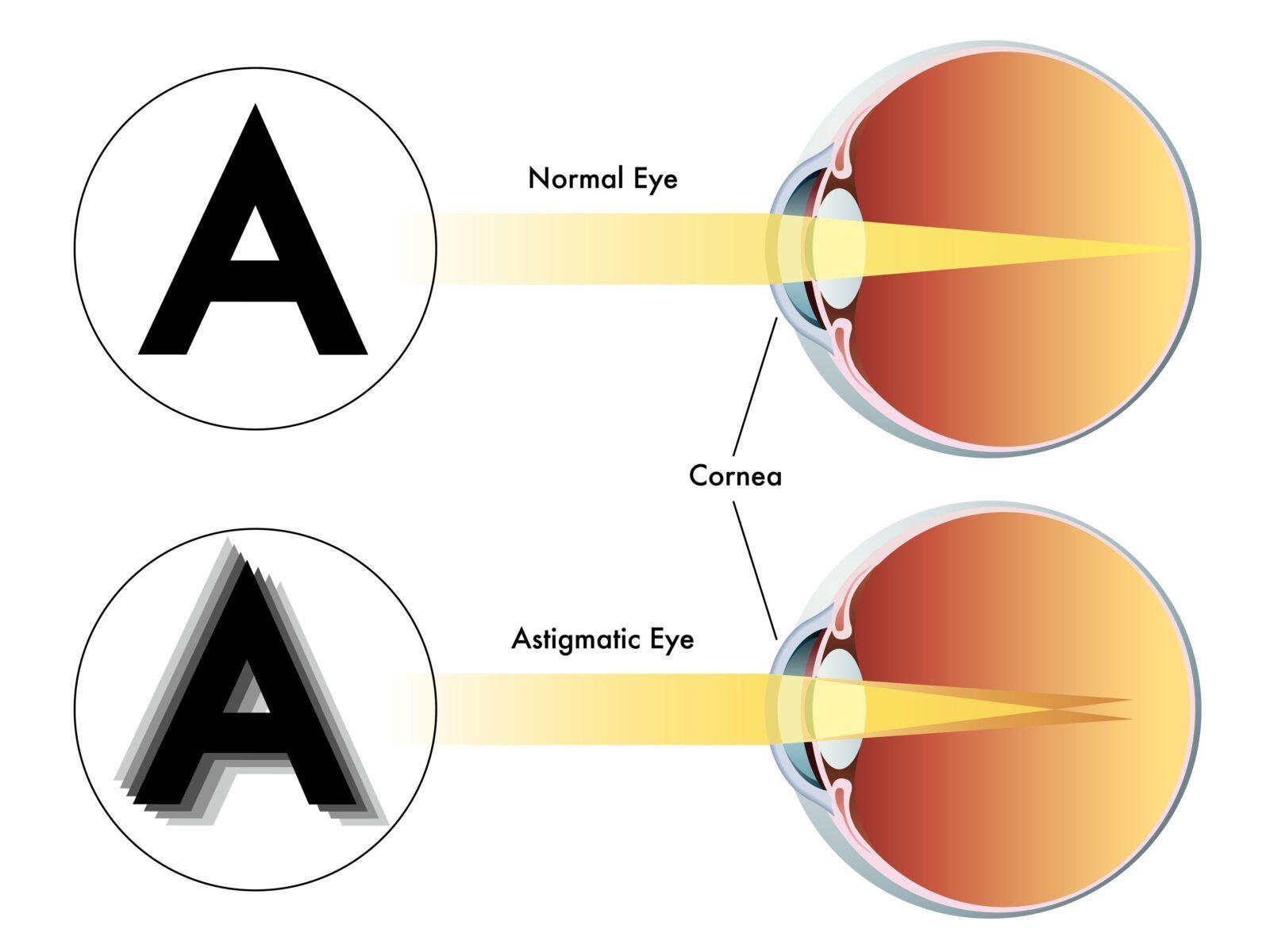 Illustration of an eye with astigmatism, showing light focusing unevenly because of an irregularly curved cornea.