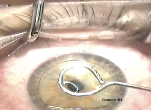 Featured image for Allotex Allogenic Corneal Inlay for Presbyopia: A Minimally Invasive Solution