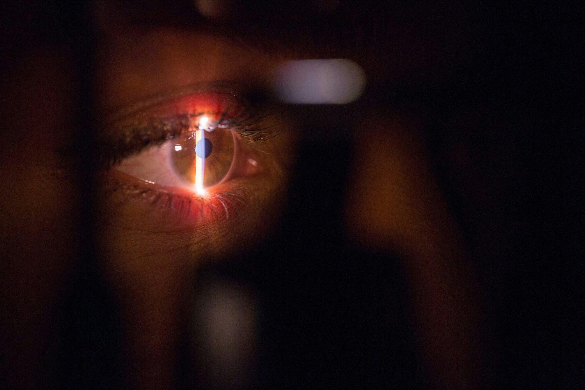 Close-up of an eye lit by the narrow beam of a slit lamp during an eye examination.