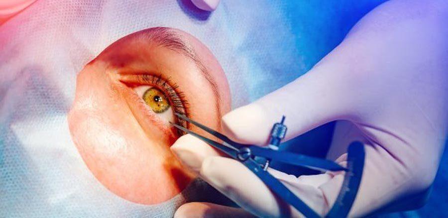A close-up of a person's eye during LASIK eye surgery. A gloved hand uses a metal medical instrument on the eye, and a surgical drape surrounds the area, exposing only the eye for precise vision correction.