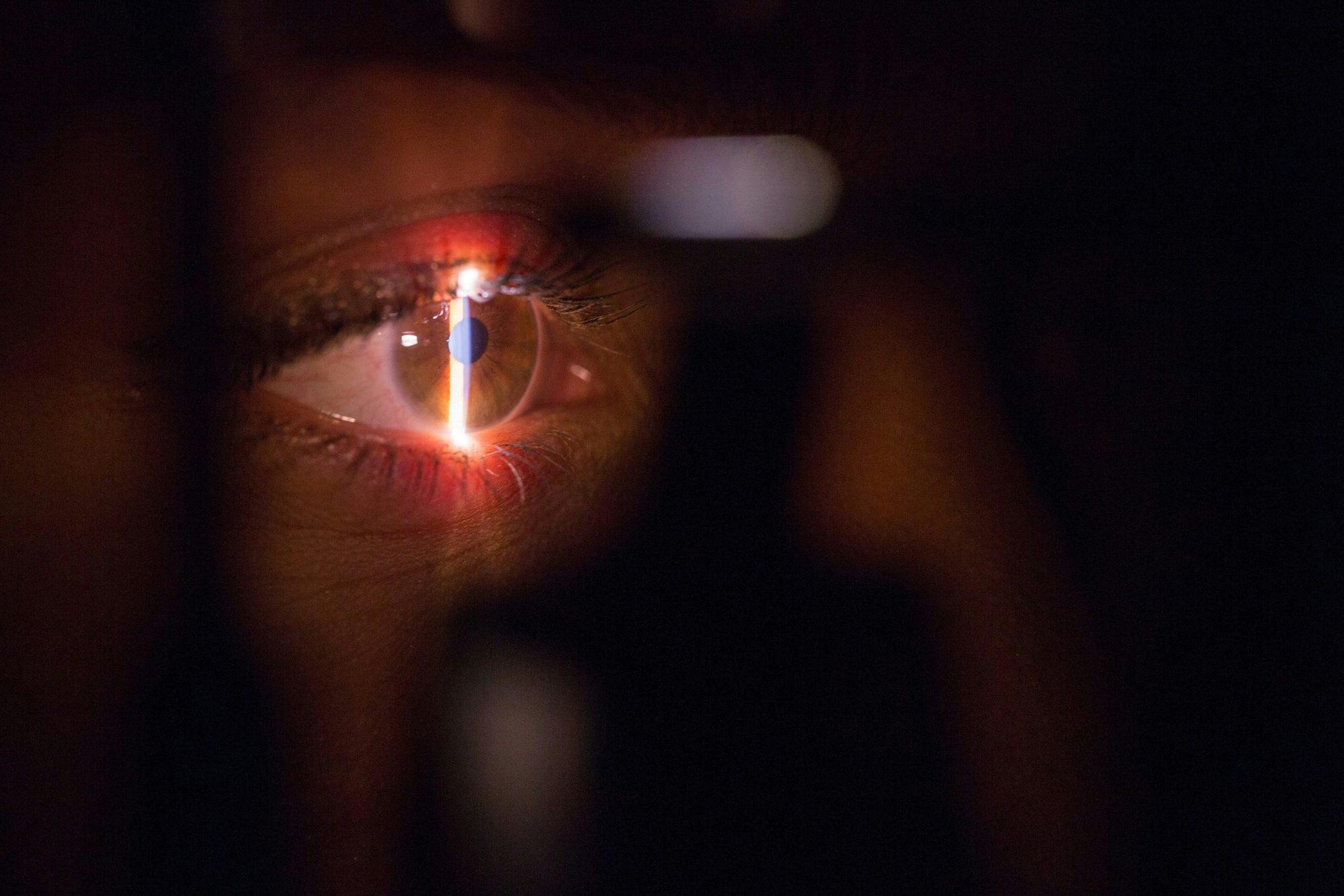 Close-up of a patient's eye during a slit-lamp examination, with the light beam crossing the cornea.