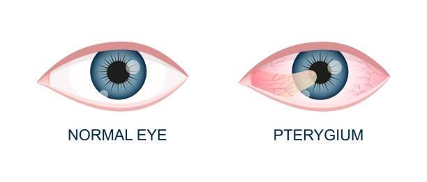 Two illustrations of eyes: the left is normal, while the right shows a pterygium—a pinkish tissue growing toward the cornea. Labels read Normal Eye and Pterygium, highlighting the importance of pterygium surgery and recovery time for clear vision.