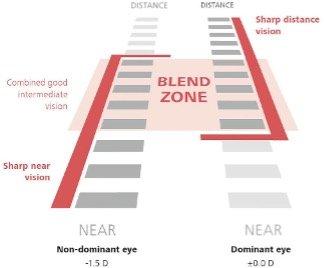 laser blended vision or mono vision