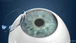 A close-up illustration of a human eye with a contact lens being placed onto the cornea against a blue background, highlighting the precision seen in implantable contact lens surgery.