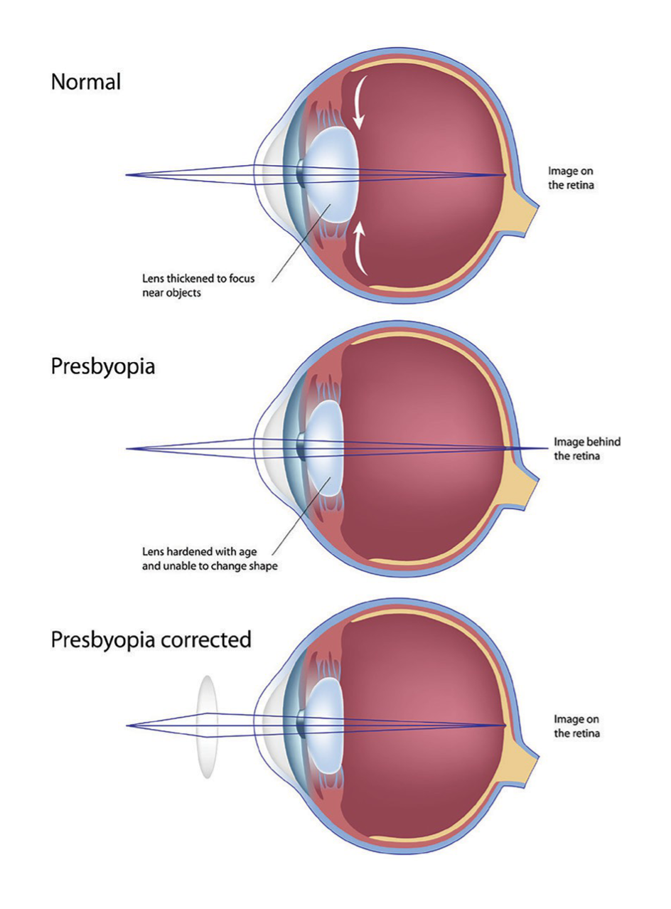 Diagram of three eyes: a young eye whose lens thickens to focus on near objects, an eye with presbyopia where the hardened lens focuses near images behind the retina, and presbyopia corrected with a reading lens.