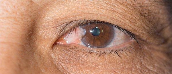 Close-up of a human eye with a cloudy, grayish spot on the lens, indicating a cataract. The surrounding skin shows fine lines and wrinkles, common concerns for those considering recovery time after pterygium surgery.