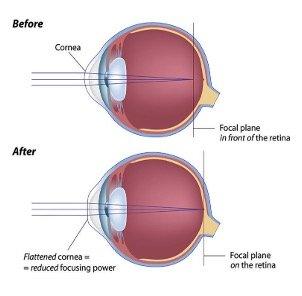 what refractive errors can be treated by laser eye surgery