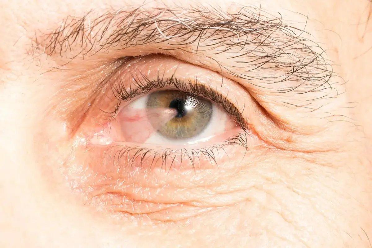 Close-up of a person’s eye after pterygium surgery, showing a green and hazel iris, detailed eyelashes, eyebrow, and visible skin texture with fine lines and wrinkles around the eye during pterygium recovery time.