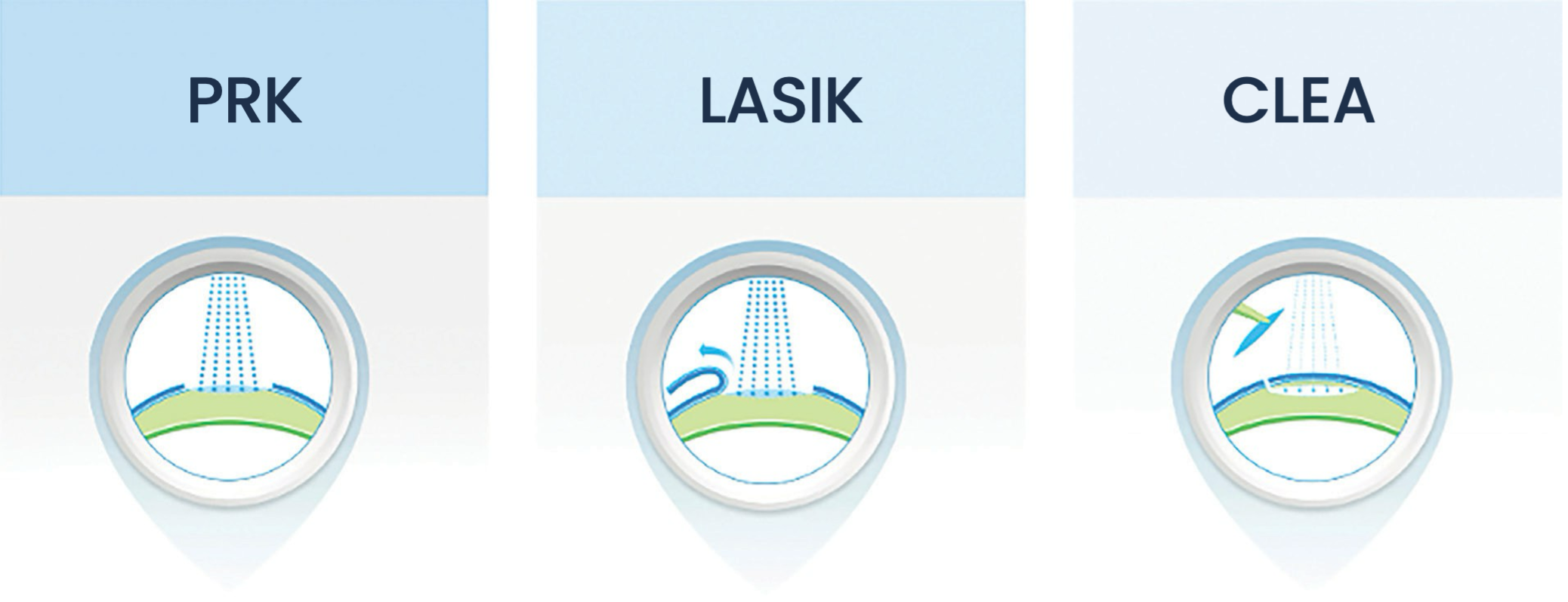 Types of laser eye surgery including LASIK, PRK, CLEAR or smile