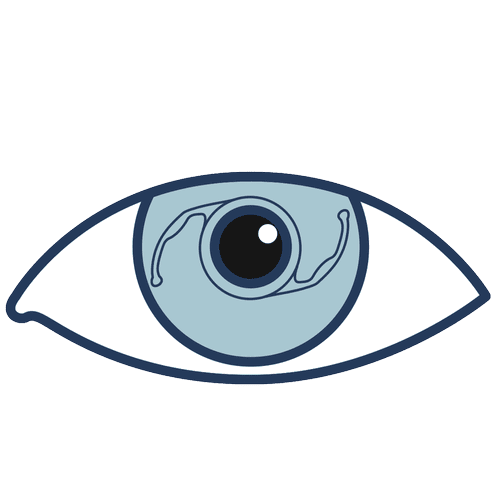Illustration of a human eye focusing on the iris and pupil, representing cataract surgery