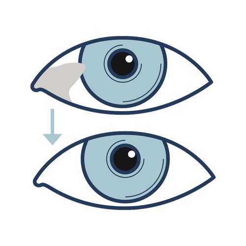 Blue before-and-after eye icon representing premium pterygium surgery in Brisbane with no-stitches approach