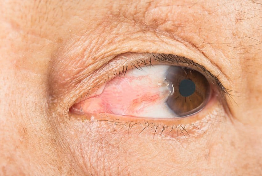 Close-up of eyes before pterygium surgery with no-stitches approach
